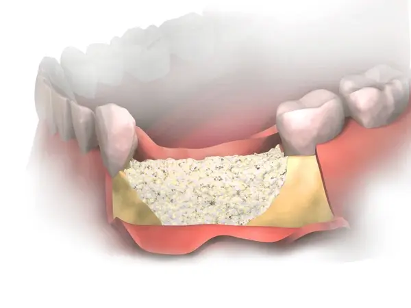 bone and soft tissue regeneration in white rock, bc