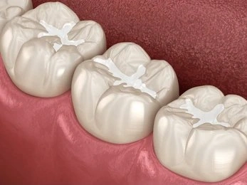 composite fillings in white rock, bc