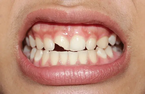 cracked teeth treatment near you