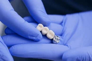 dental bridges in white rock, bc