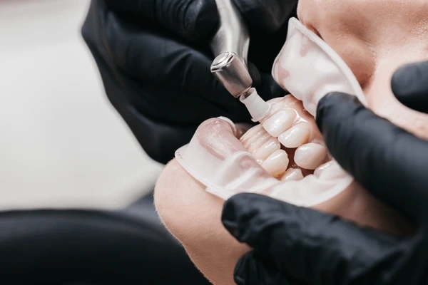 dental cleanings in white rock, bc