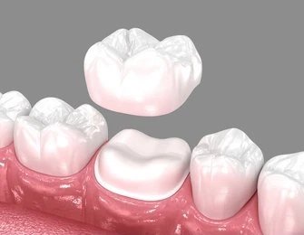 dental crowns in white rock, bc