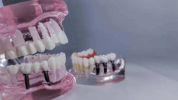 dental implants in white rock, bc