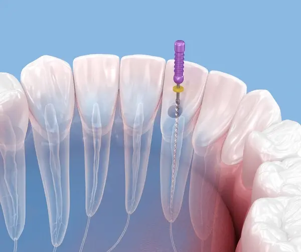 endodontic retreatment near you