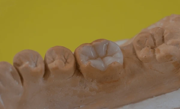 inlay and onlay restorations in white rock, bc