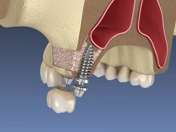 sinus lift surgery near you