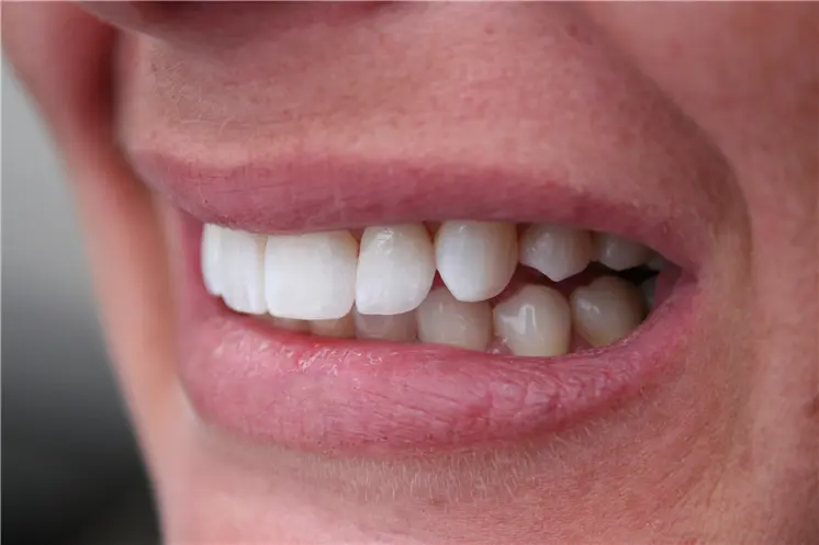 after side smile view showing restored lateral incisor perfectly matching adjacent white teeth