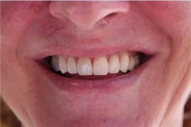 after smile view of aligned upper teeth with closed central gap