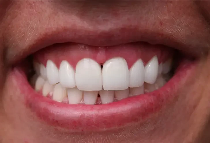 after smile view of bright straight upper arch with closed central gap