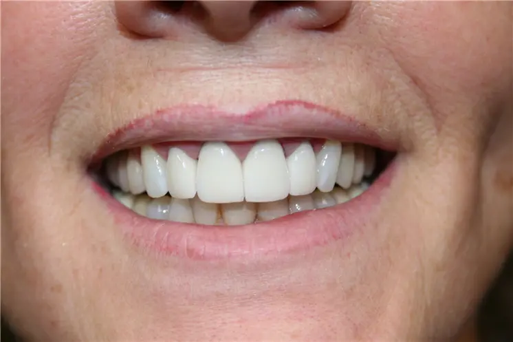 after smile view of bright uniform upper arch restoration