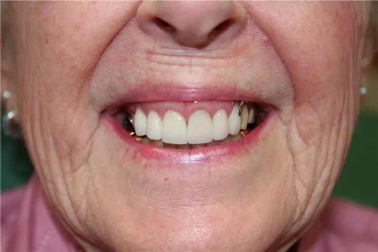 after smile view of full upper arch restoration with clean natural teeth