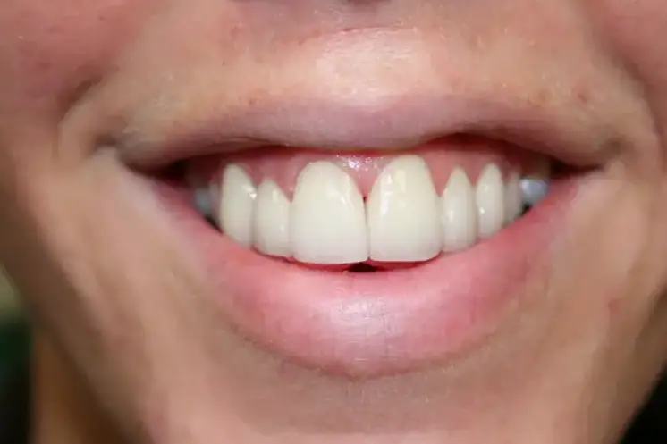 after smile view of restored upper front tooth matching adjacent teeth