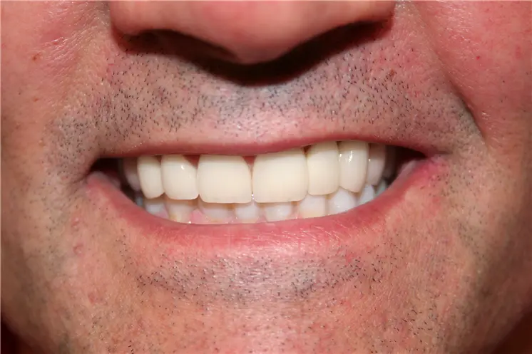 after smile view of restored upper teeth with smooth uniform edges