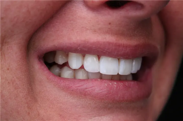 after smile view of smooth aligned upper teeth with closed space