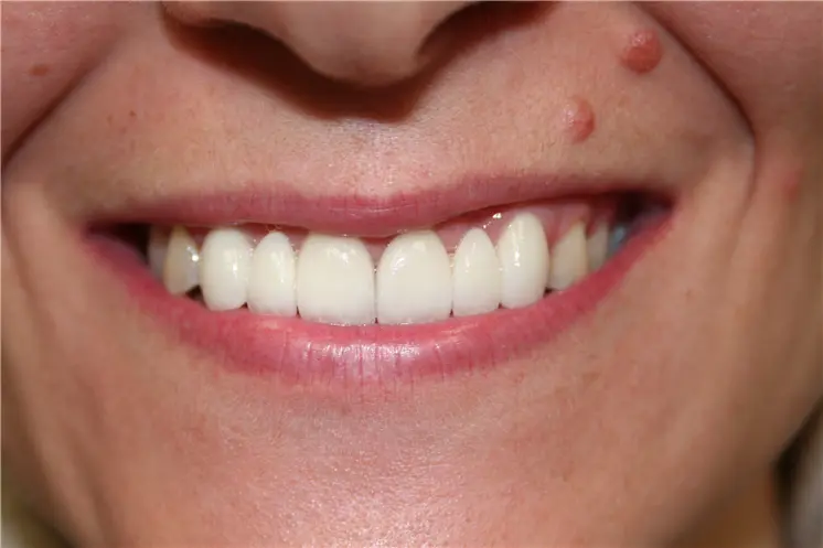 after smile view of smoothly aligned upper veneers with a refreshed natural finish