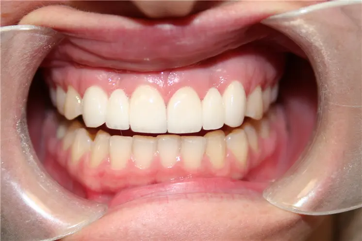 after view with cheek retractor showing bright natural upper crown restoration with clean gumline