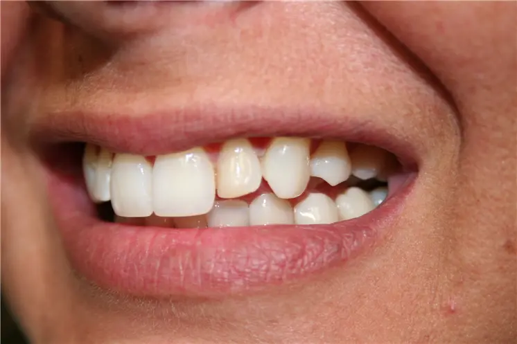 before side smile view showing single yellowish discolored lateral incisor tooth
