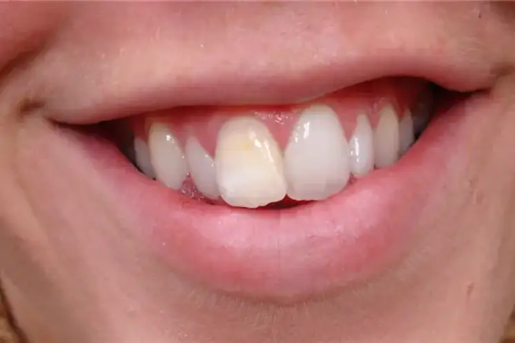 before smile view of discolored upper front central tooth