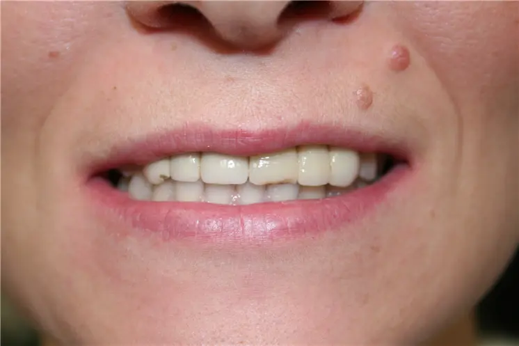 before smile view of discolored upper teeth with chipped central incisor and skin moles on the left cheek