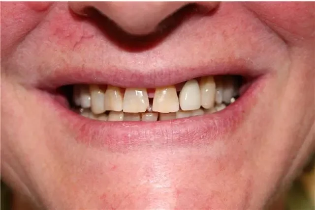 before smile view of discolored worn teeth with gap between central incisors