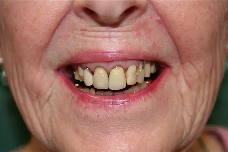 before smile view of severely discolored worn teeth with gumline decay