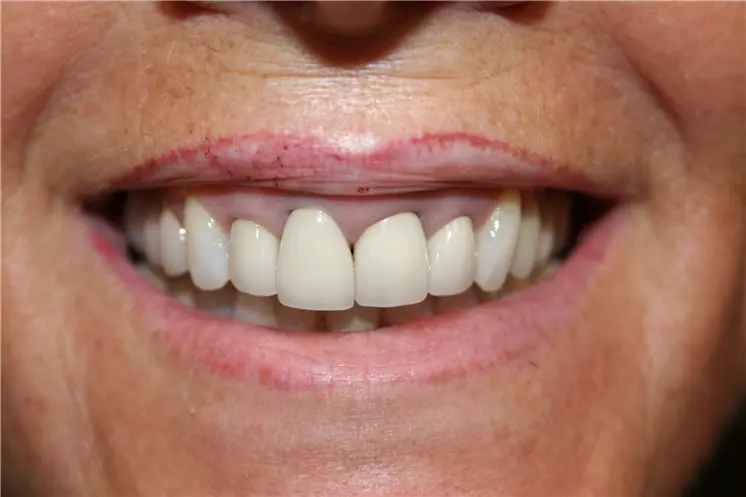 before smile view of stained upper teeth with dark spaces near gums
