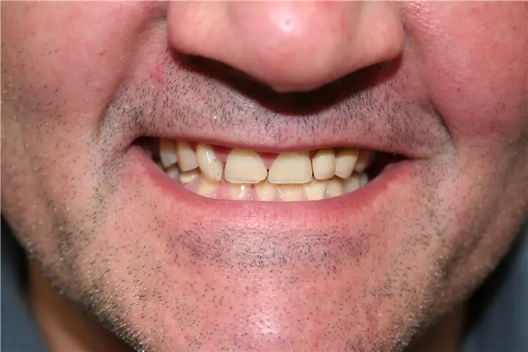before smile view of worn chipped upper teeth with dark uneven edges