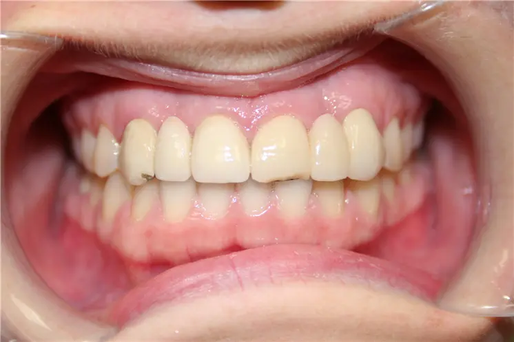 before view with cheek retractor showing discolored upper crowns with visible margin lines near the gums